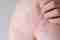 Orticaria